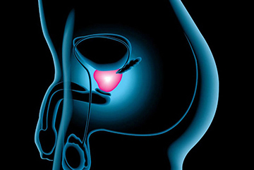 Prostatectomia laparoscópica