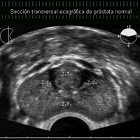 ENFERMEDADES DE LA PRÓSTATA